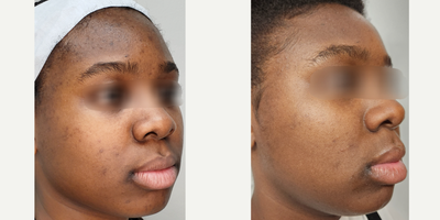Facial before and after photo