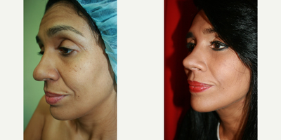Rhinoplasty before and after photo
