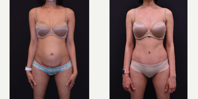 Tummy Tuck before and after photo