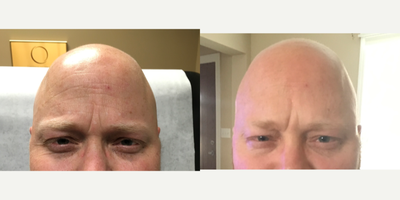 Botox before and after photo