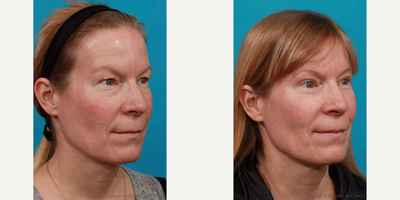 Eyelid Surgery before and after photo