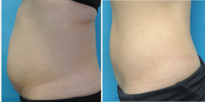 Laser Liposuction before and after photo