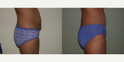 Tummy Tuck before and after photo
