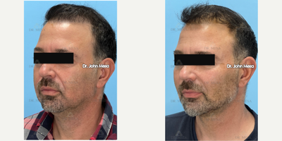AccuTite before and after photo
