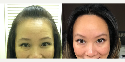 Botox before and after photo