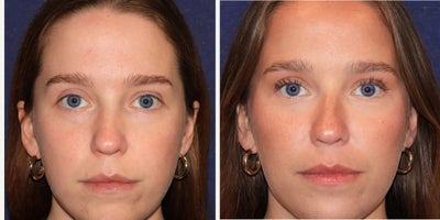 Botox before and after photo