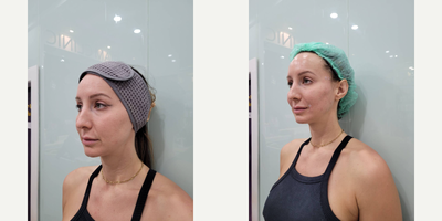Cheek Fillers before and after photo