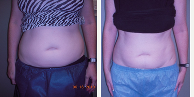 CoolSculpting before and after photo