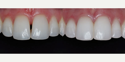 Dental Bonding before and after photo