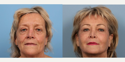 Laser Resurfacing before and after photo