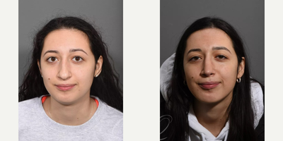 Rhinoplasty before and after photo