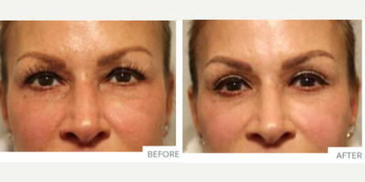 Eyelid Surgery before and after photo
