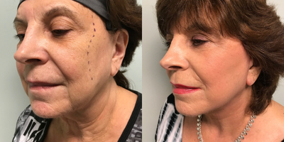 Facelift Revision before and after photo