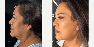 Facelift before and after photo