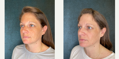Halo Laser before and after photo