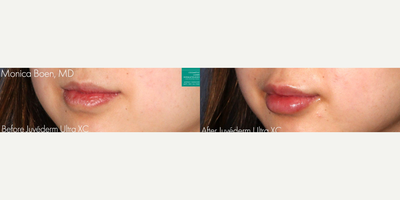 Juvederm before and after photo