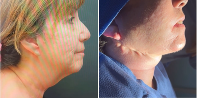 Liposuction before and after photo