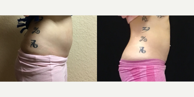 truSculpt before and after photo