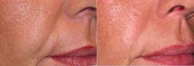 ArteFill before and after photo