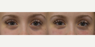 Dermal Fillers before and after photo