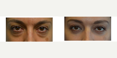 Eyelid Surgery before and after photo