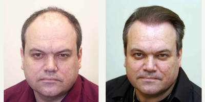 Hair Transplant before and after photo