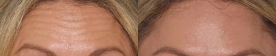 Botox before and after photo