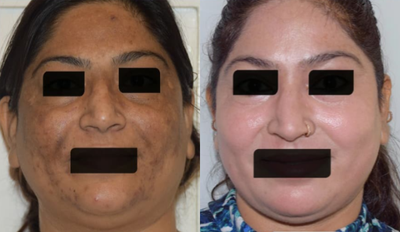Dermabrasion before and after photo