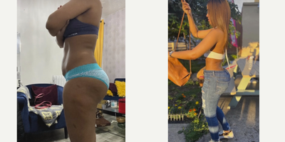 Tummy Tuck before and after photo