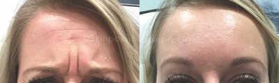 Botox before and after photo