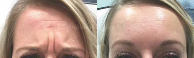 Botox before and after photo