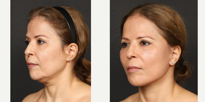 Deep Plane Facelift before and after photo