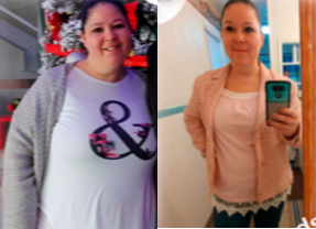 Gastric Bypass before and after photo