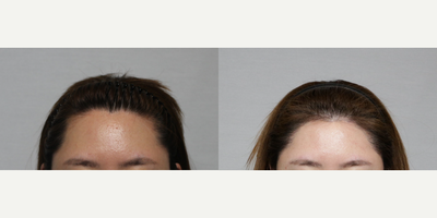 Hair Transplant before and after photo
