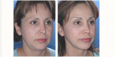 Mini Facelift before and after photo