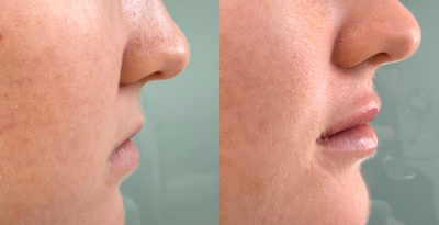 Nonsurgical Nose Job before and after photo