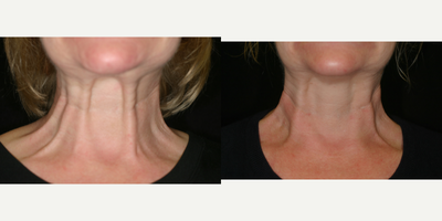 Botox before and after photo