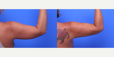 Chin Liposuction before and after photo
