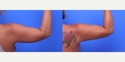 Chin Liposuction before and after photo