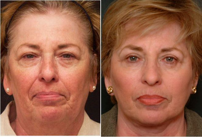 Eyelid Surgery before and after photo