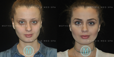 Hair Transplant before and after photo