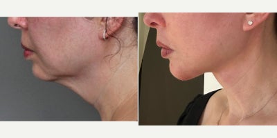 Neck Lift before and after photo