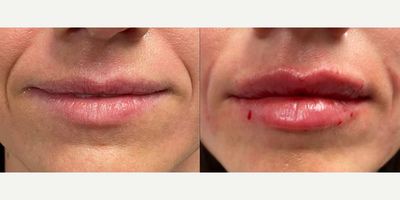 Restylane Kysse before and after photo
