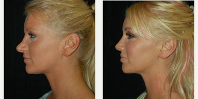 Revision Rhinoplasty before and after photo