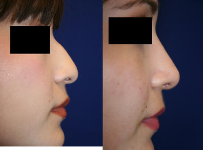 Rhinoplasty before and after photo