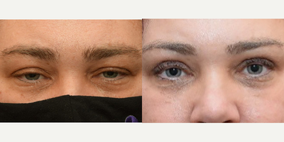 Eyelid Surgery before and after photo