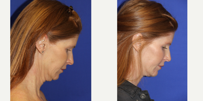 FaceTite before and after photo