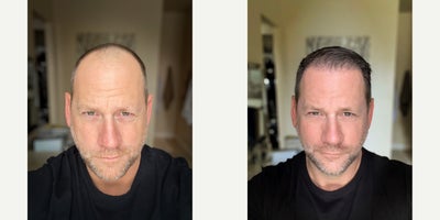 Hair Transplant before and after photo