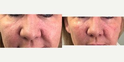 Radiesse before and after photo