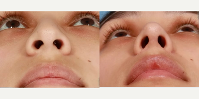 Rhinoplasty before and after photo